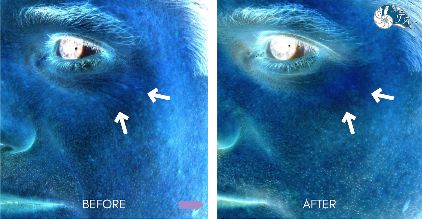 RF microneedling